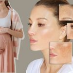 gravidanza melasma