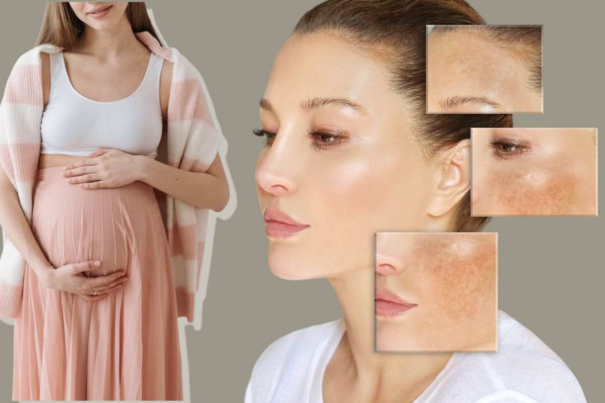 gravidanza melasma