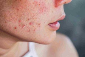 combattere acne