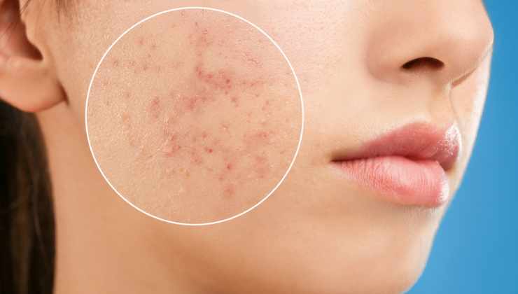 Scoperta incredibile per curare l'acne